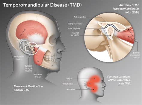 tmj syndrome – Ericvisser