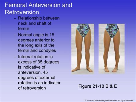 Femoral Anteversion And Retroversion