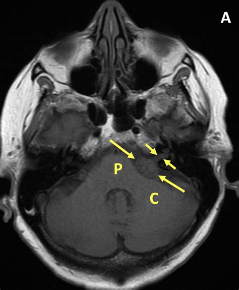 Vestibular Schwannoma - MRI Online