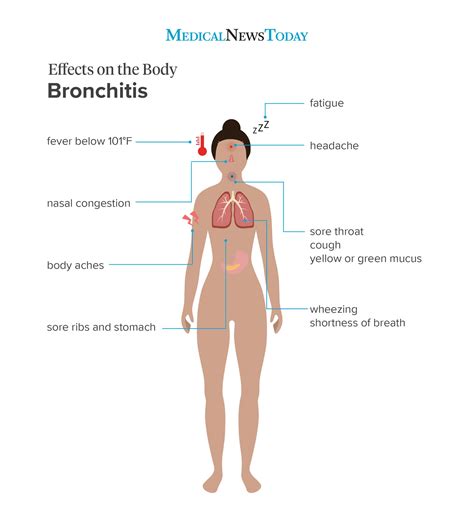 How To Cure Acute Bronchitis - Internaljapan9