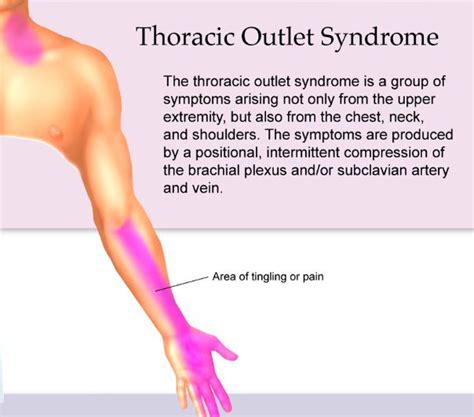 Thoracic Outlet Syndrome and Chiropractic