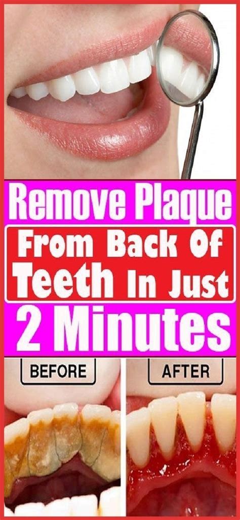 Remove Plaque From Your Teeth Just In 2 Minutes! in 2020 | Healthy ...