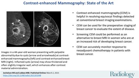 Contrast-enhanced Mammography: State of the Art | Radiology