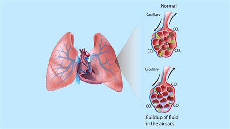 Pulmonary Edema: Symptoms, Diagnosis, Prevention