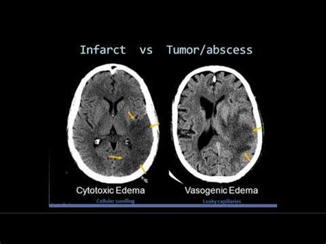 Intro to Head CT Part II: Evaluation of Ischemic Stroke - YouTube