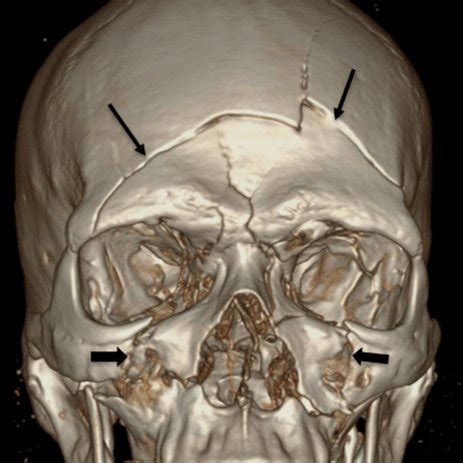 Le fort I, II and III fracture (A) anterior view (B) lateral view. (C ...