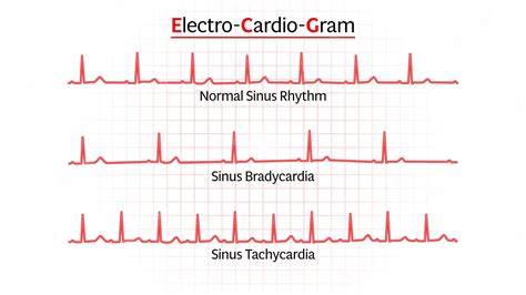 Premium Vector | Set of ecg common case normal sinus rhythm sinus ...