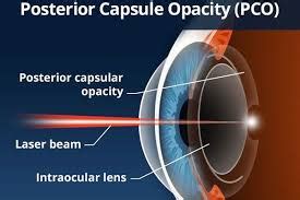 YAG Laser Procedure After Cataract Surgery - Columbia Eye