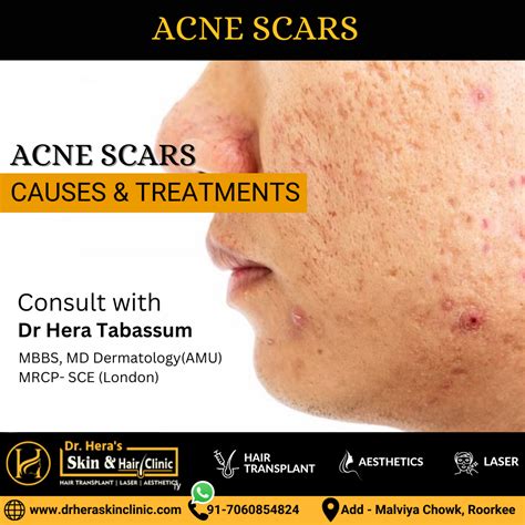 Acne Scars: Causes And Treatments - Dermatologist in Roorkee