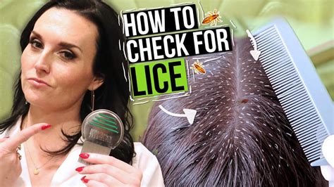 How To Check For Head Lice - Fatintroduction28