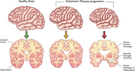 Advanced Stages of Alzheimer's: Understanding the Stages - Altoida