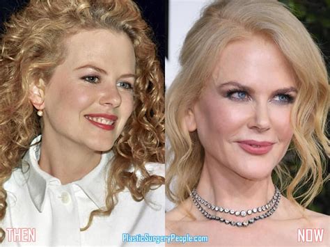 Did Nicole Kidman Have Facelift & Lip Augmentation?