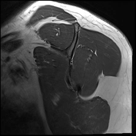 Normal shoulder MRI arthrogram | Image | Radiopaedia.org