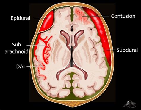 Intraparenchymal Hemorrhage Vs Subarachnoid Hemorrhage