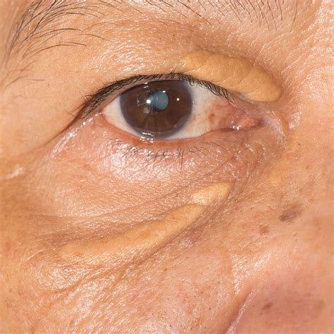 Yellow Areas on Eyelids (Xanthelasma) | Faciem Dermatology Clinic