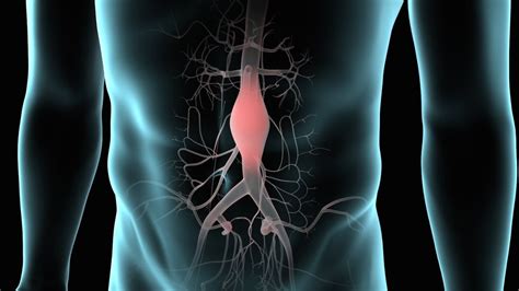 ABDOMINAL AORTIC ANEURYSMS - Medical Yukti