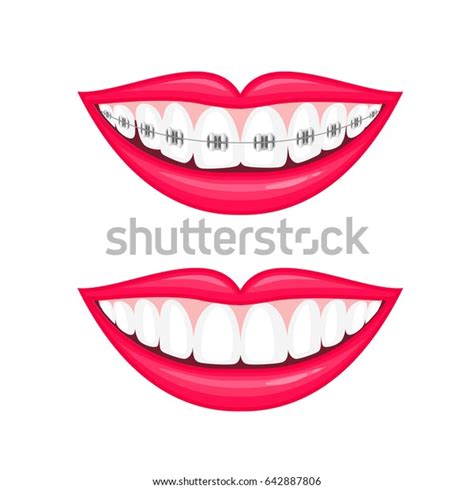 Perfect Teeth Before After Braces Vector Stock Vector (Royalty Free ...