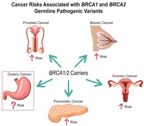 Cancers | Free Full-Text | Gastric Cancer Risk and Pathogenesis in ...