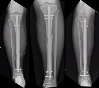 Tibia compression fracture treatment - lopiren