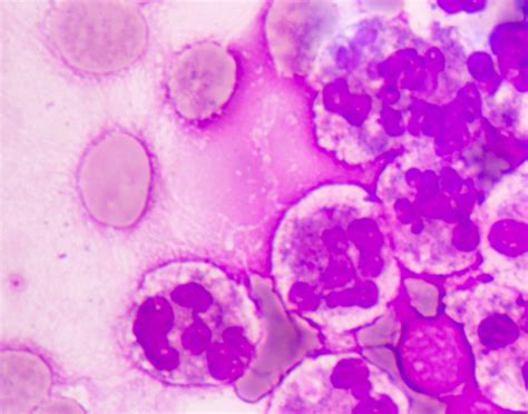 Cytology exam of pleural fluid