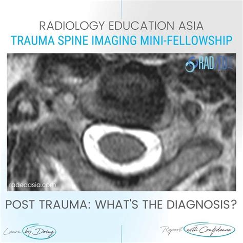 VERTEBRAL ARTERY DISSECTION RADIOLOGY MRI DIAGNOSIS - Radedasia