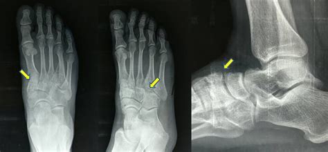 Cureus | Post-traumatic Arthritis of the Tarsometatarsal Joint Complex ...