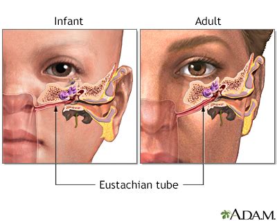 Ear Infection - Middle Ear (Otitis Media) - Symptoms and Causes