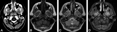 Lateral Pterygoid Muscle Rhabdomyolysis | American Journal of ...