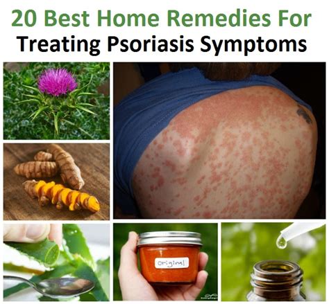 20 Best Home Remedies For Treating Psoriasis Symptoms