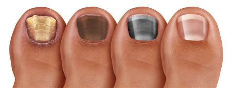 Toenail Discoloration making you unhappy? There is a way out!