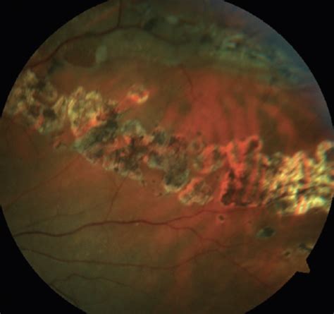 Lattice Degeneration of Retina - Synergy Eye Care