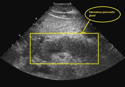 Acute pancreatitis ultrasound - wikidoc