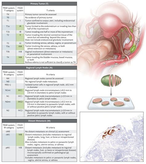 Endometrial Cancer Symptoms Staging Treatment And Causes - Riset