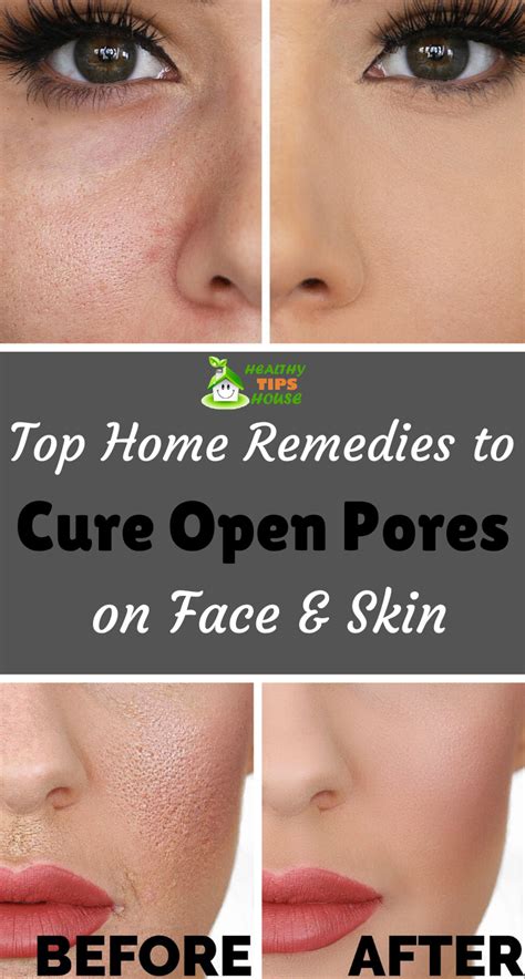 Use these natural remedies to put an end to Open Pores! | Open pores on ...