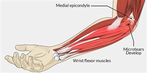 4 Step Golfers Elbow Treatment Plan - Precision Movement