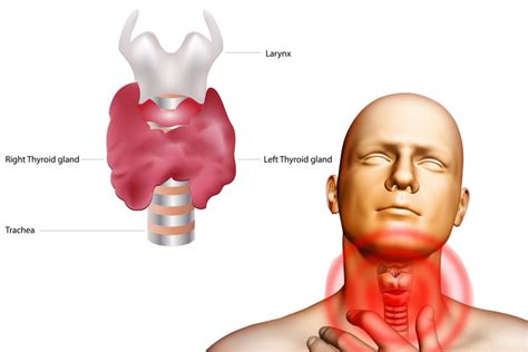 Thyroid Pain | Hyperthyroidism & Hypothyroidism