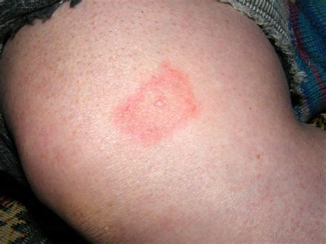 Lyme Disease Rash Photos: Early-Stage, Bull’s-Eye, and Atypical Rashes ...