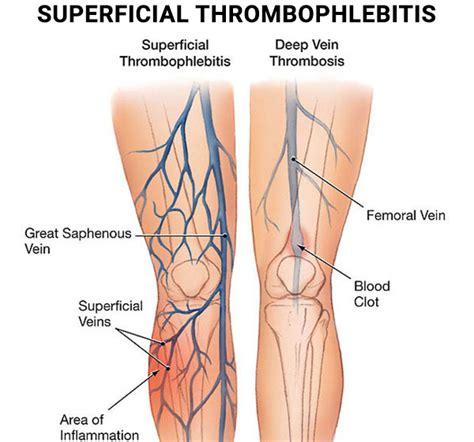 Superficial Thrombophlebitis (ST) Treatment - Professional Product By ...