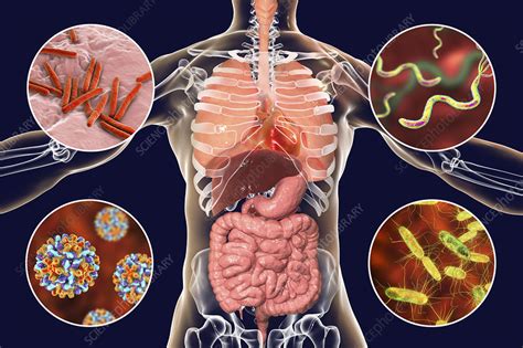 Bacterial Infection