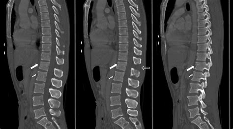 Let's review Chance fracture | BMJ Case Reports