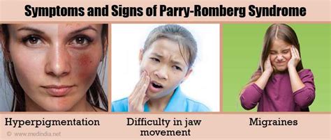 Symptoms and Signs of Parry-Romberg Syndrome