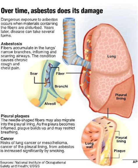 Mesothelioma info: Asbestosis, Cancer Asbestos, Mesothelioma Symptoms ...