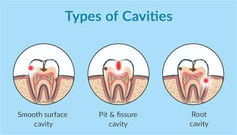 Tooth Decay Symptons, Causes, Treatment - Nearby Dental