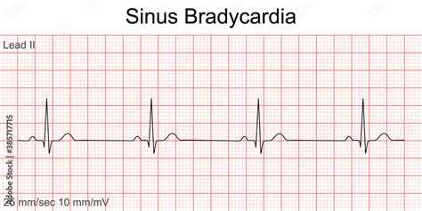 Electrocardiogram show Sinus bradycardia pattern. Cardiac fibrillation ...