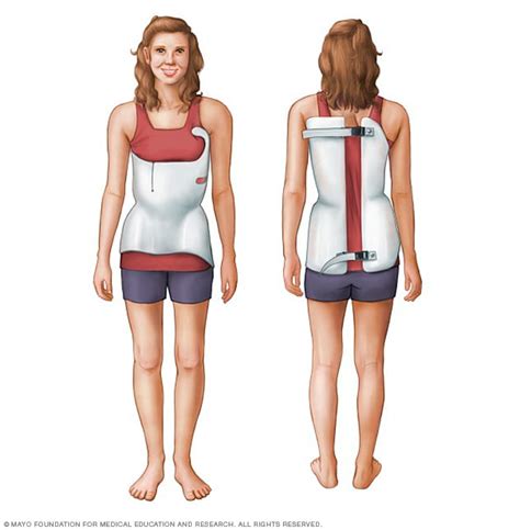 Scoliosis brace - Mayo Clinic