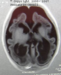 Lissencephaly Syndrome