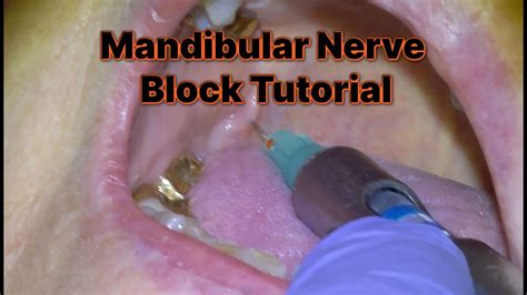 [1] How to Administer a Mandibular Nerve Block - YouTube