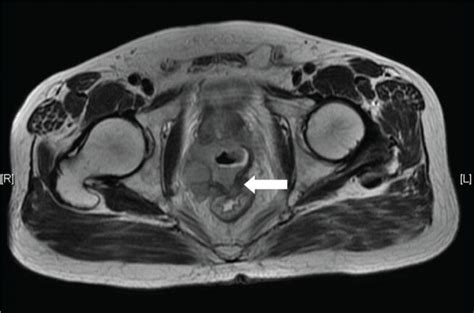 Prostate Cancer Mri Images