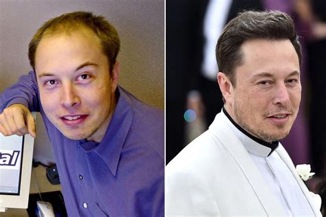 It’s ‘highly likely’ Elon Musk spent over $20K on hair transplant ...