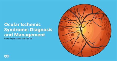 Ocular Ischemic Syndrome: Diagnosis and Management